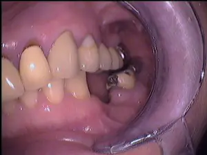 Zahnarzt-Zaehnsationell-Zehlendorf-implantat-1a
