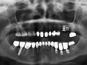 Zahnarzt-Zaehnsationell-Zehlendorf-implantat-3a